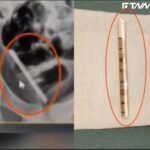 男童「體溫計塞尿道」斷一半滑進膀胱 拿出來長達6.5公分!
